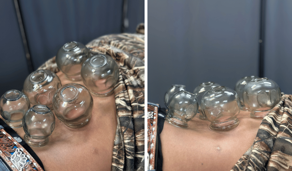 Fire Cupping | Top-Rated Chiropractor In Lubbock, Tx June 15, 2026 Fire cupping in lubbock tx