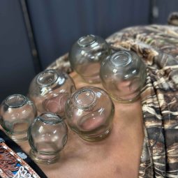 Fire-Cupping Fire cupping in lubbock tx